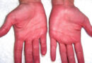 Ako vam dlanovi ovako izgledaju, moguće je da je jetra ozbiljno bolesna